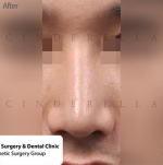 Rhinoplasty