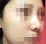 Rhinoplasty