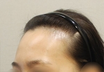 hairline