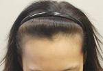 hairline