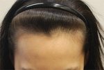 hairline