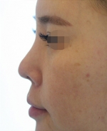 Rhinoplasty