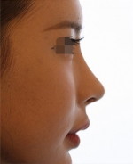 Rhinoplasty