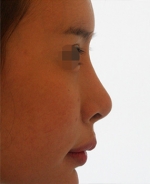 Rhinoplasty