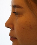 Rhinoplasty