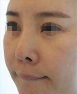 Rhinoplasty