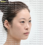 Rhinoplasty