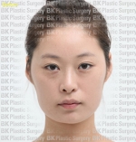 Rhinoplasty