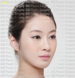 Rhinoplasty