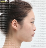 Rhinoplasty