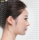 Rhinoplasty