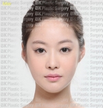 Rhinoplasty