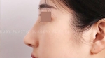 Rhinoplasty