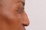 Rhinoplasty