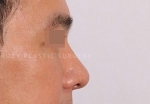 Rhinoplasty