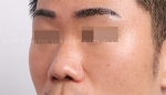 Rhinoplasty