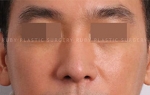 Rhinoplasty