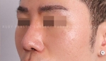 Rhinoplasty