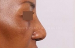 Rhinoplasty