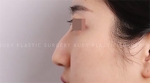 Rhinoplasty