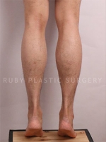 Liposuction