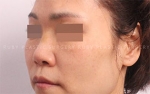 Rhinoplasty