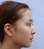 Rhinoplasty