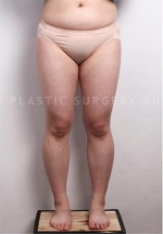 Liposuction