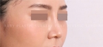 Rhinoplasty