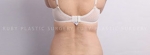 Liposuction