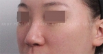 Rhinoplasty