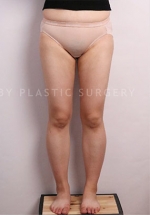 Liposuction