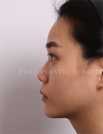 Rhinoplasty