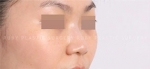 Rhinoplasty