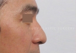 Rhinoplasty