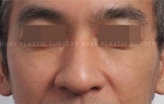 Rhinoplasty