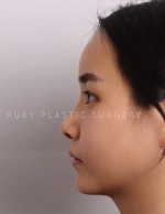 Rhinoplasty