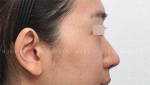 Rhinoplasty