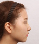 Rhinoplasty