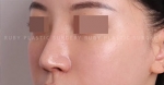 Rhinoplasty