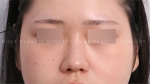 Rhinoplasty