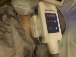 Coolsculpting (zeltiq) procedure at wannabe clinic