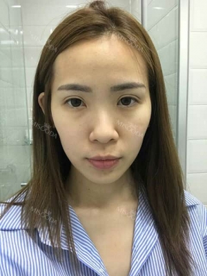 韓国での顎の縮小、鼻形成術、豊胸手術