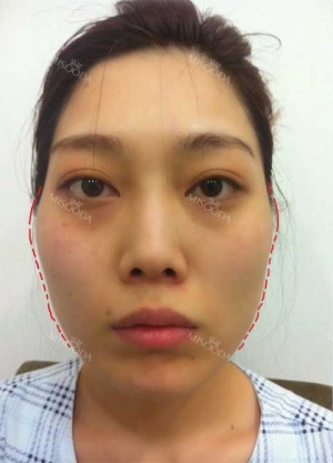 New V-Line, Zygoma Reduction & Rhinoplasty & Fat Graft