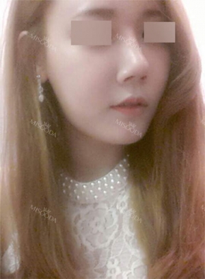 Rhinoplasty~!