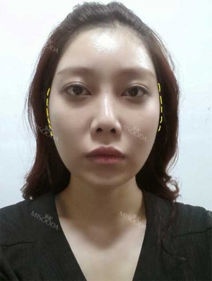 New V-Line, Zygoma Reduction & Rhinoplasty & Fat Graft