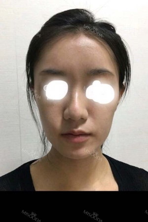 Sedot Lemak Paha, Transfer Lemak Seluruh Wajah dan Suntik Filler Hidung