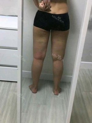 Thigh Liposuction+Calf Botox