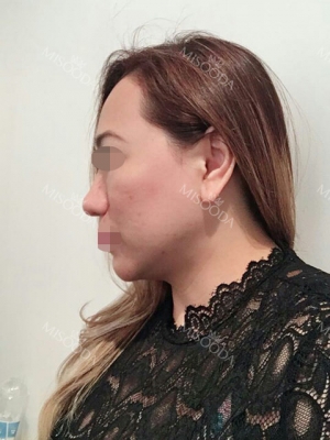 Revision Rhinoplasty, Fat graft, Skin Injection