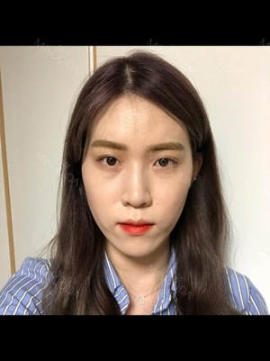 Double Eyelid + Rhinoplasty + Fat Graft + Facial Contour